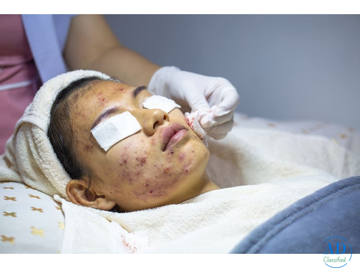 Advanced Acne Scar Treatment in Dubai for Clear & Healthy Skin