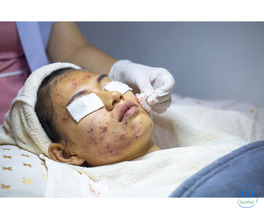 Advanced Acne Scar Treatment in Dubai for Clear &amp; Healthy Skin
