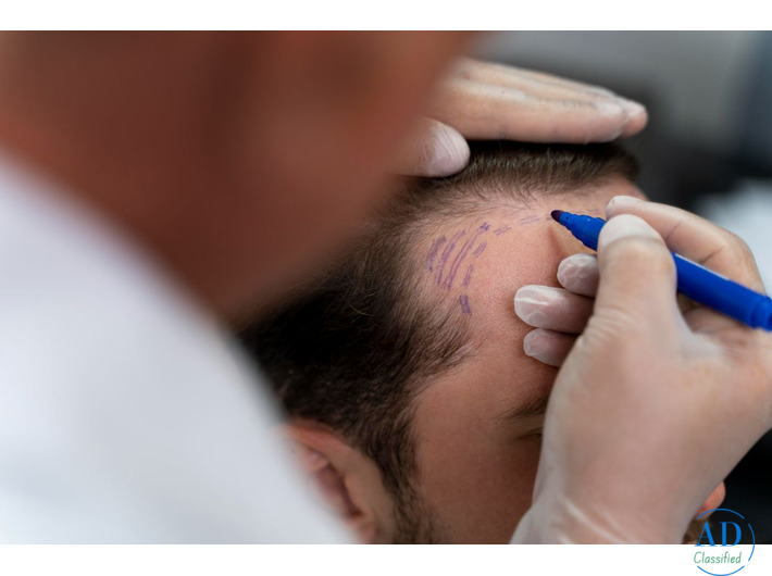 Get Back Your Hair and Confidence with Hair Transplant