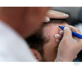 Get Back Your Hair and Confidence with Hair Transplant