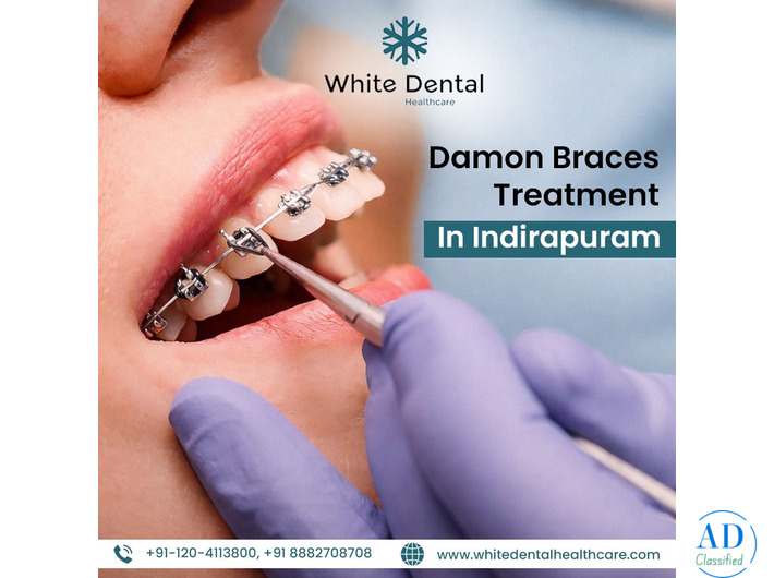 Damon Braces Treatment in Indirapuram for Perfect Smile