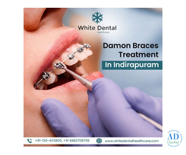 Damon Braces Treatment in Indirapuram for Perfect Smile