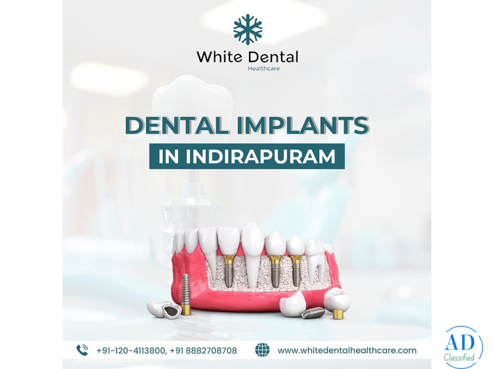 Dental Implants in Indirapuram for Healthy and Strong Teeth