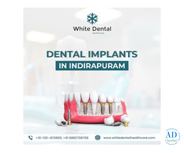 Dental Implants in Indirapuram for Healthy and Strong Teeth