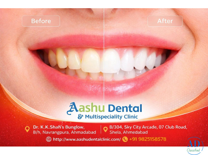 Restore Your Smile with Full Mouth Rehabilitation Treatment