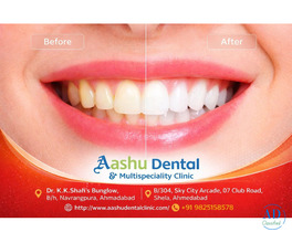 Restore Your Smile with Full Mouth Rehabilitation Treatment