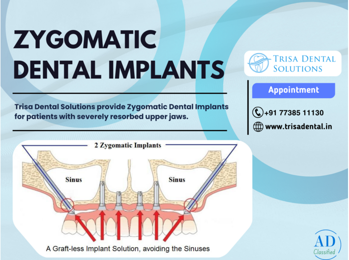 Zygomatic Dental Implants in Mumbai – No Bone Grafting Required