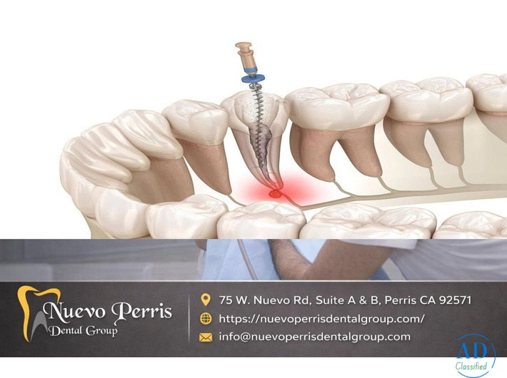 Top-Rated Root Canal Treatment in Menifee – Gentle Dentistry