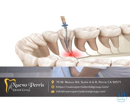 Top-Rated Root Canal Treatment in Menifee – Gentle Dentistry