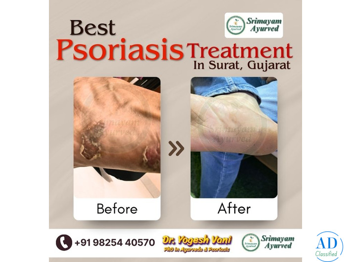 SRIMAYAM AYURVED - Psoriasis treatment in Gujarat