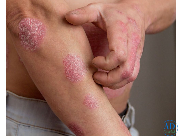 SRIMAYAM AYURVED - Psoriasis treatment in Gujarat