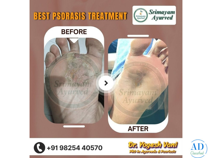SRIMAYAM AYURVED - Psoriasis treatment in Gujarat