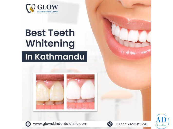 Best Teeth Whitening in Kathmandu