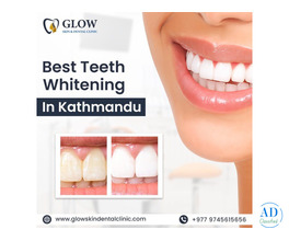 Best Teeth Whitening in Kathmandu
