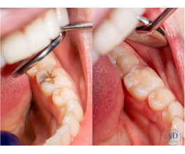 Tooth Colored Fillings Treatment in Lake Elsinore – Dr. Tejas Modi