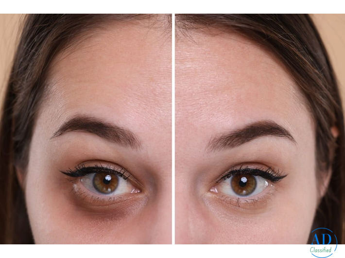 Advanced Dark Circle Treatment in Dubai for Brighter, Youthful Eyes