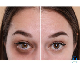 Advanced Dark Circle Treatment in Dubai for Brighter, Youthful Eyes