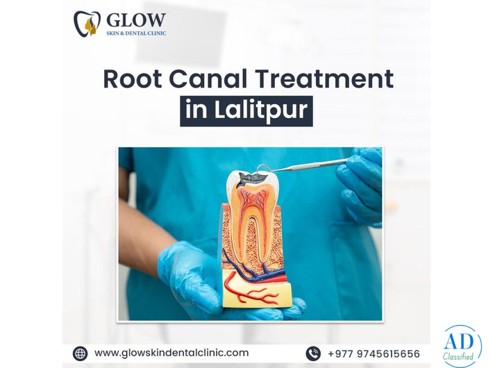 Root Canal Treatment in Lalitpur