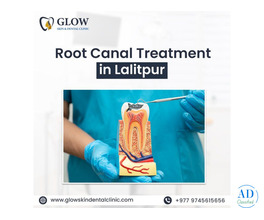 Root Canal Treatment in Lalitpur