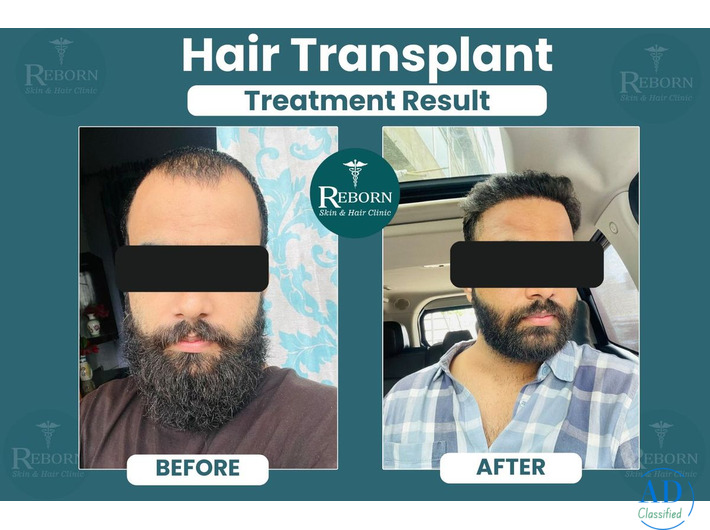 Hair Transplant in Jaipur - Natural and Permanent Hair Loss Solutions