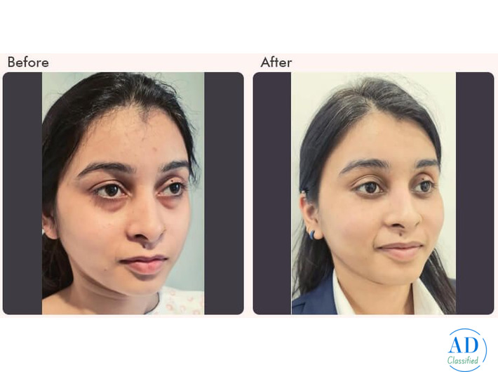 Eyelid Surgery in Delhi - Dr Rajat Gupta