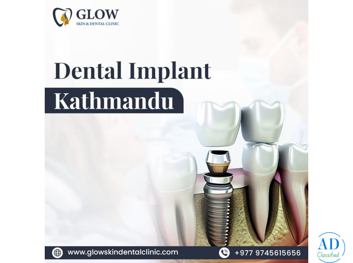 Best Dental Implant Kathmandu