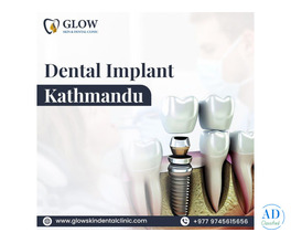 Best Dental Implant Kathmandu