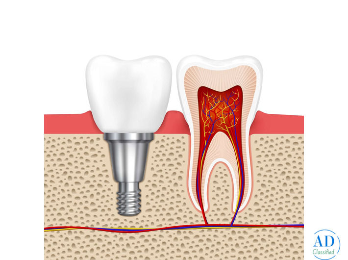 Dental Implants at White Dental Healthcare