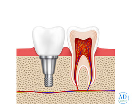 Dental Implants at White Dental Healthcare