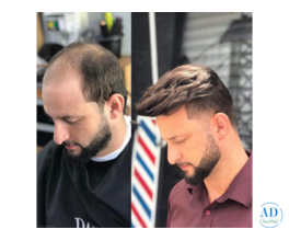 Buy Toupee for Men Online with Easy Fit and Natural Appearance