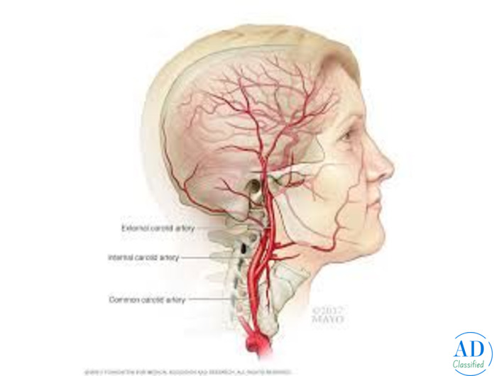 Carotid Angioplasty with Stent: Safe and Innovative Solution for Blocked Neck Arteries