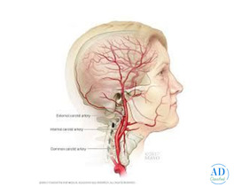 Carotid Angioplasty with Stent: Safe and Innovative Solution for Blocked Neck Arteries