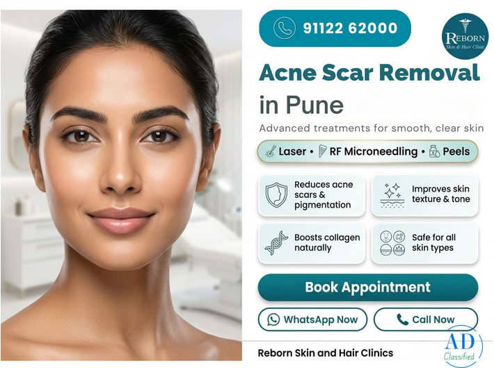 Acne Scar Removal in Karve Road near FC Road