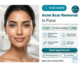 Acne Scar Removal in Karve Road near FC Road