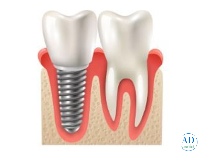 Dental Implant Treatment in Silchar | Advanced Care by Dento Derma