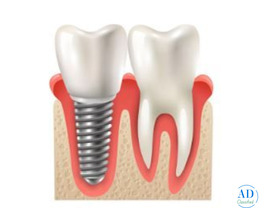 Dental Implant Treatment in Silchar | Advanced Care by Dento Derma