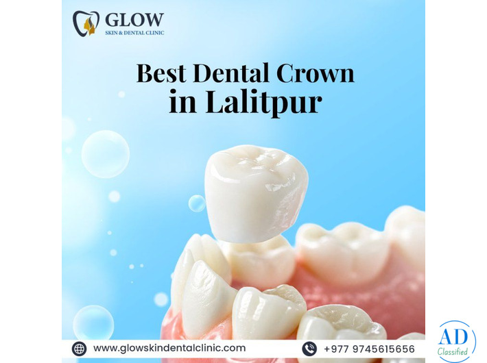 Best Dental Crown in Lalitpur