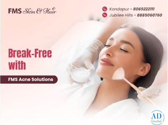 Best Acne Treatment in Hyderabad – FMS Skin & Hair