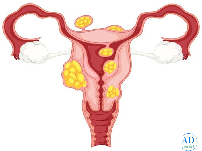 PCOS Treatment in Ahmedabad | PCOS Symptoms & Best Gynecologist in Ahmedabad