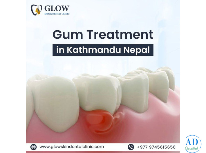 Best Gum treatment in Kathmandu Nepal