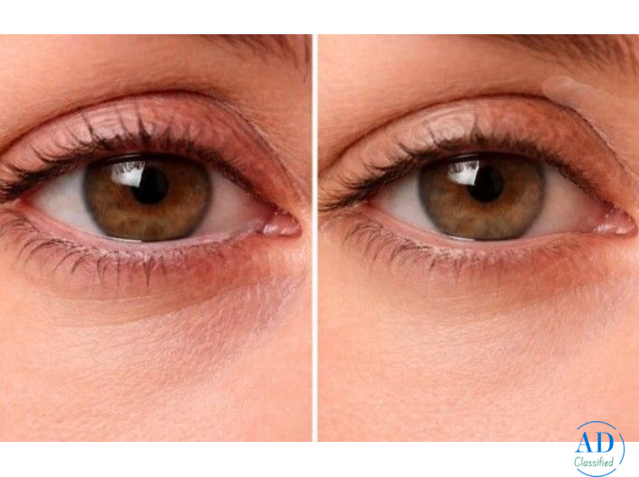 Dry Eye Syndrome and Blepharitis in Glasgow