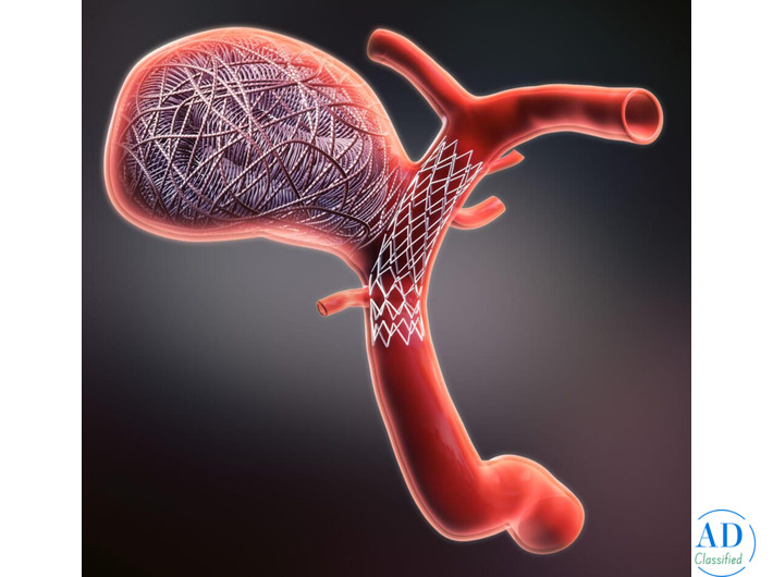 Aneurysm Coiling Treatment with Advanced Care