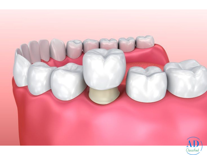 Cosmetic Dental Crowns & Veneers in Perris - Dr. Tejas Modi