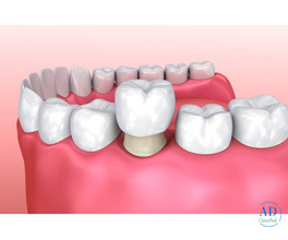 Cosmetic Dental Crowns & Veneers in Perris - Dr. Tejas Modi