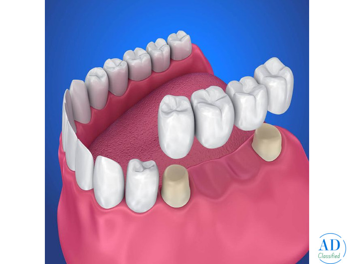 Best Tooth Crown & Dental Bridges Treatment in Thoothukudi