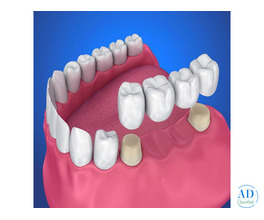Best Tooth Crown & Dental Bridges Treatment in Thoothukudi