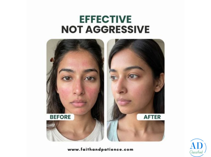 Ceramide Moisturizer for Acne Prone Skin – Hydrate Without Breakouts