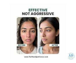 Ceramide Moisturizer for Acne Prone Skin – Hydrate Without Breakouts