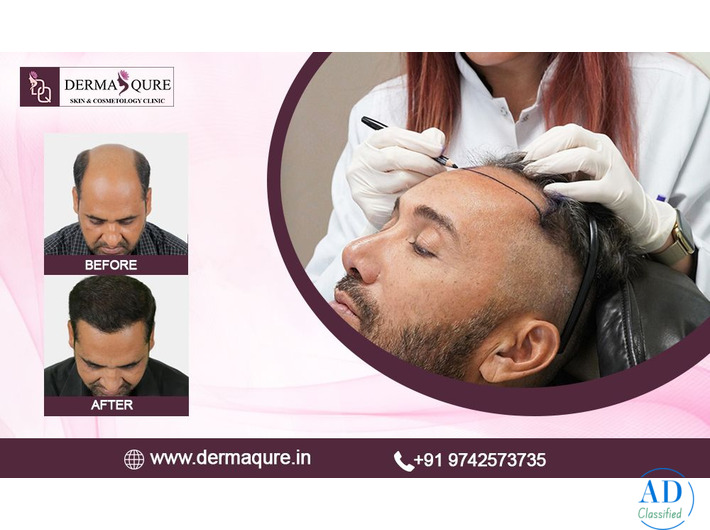 Advanced Hair Transplant Treatment in Surat - Callisto Clinic
