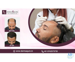Advanced Hair Transplant Treatment in Surat - Callisto Clinic